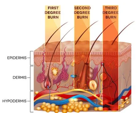 Skin burn classification Stock Illustration