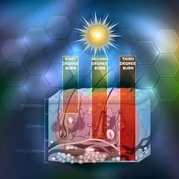 Skin burn classification Stock Illustration