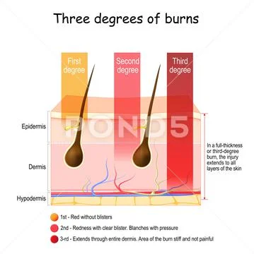 Skin Burn. Three Degrees Of Burns. Type Of Injury To Skin Illustration ...