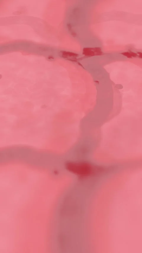 Skin Cells up Close on Human Dermis - Rosacea of Enflamed Psoriasis - Vertic 動画素材 333156795