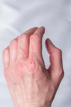 Skin condition after a cat scratch and bite. A hand scratched by a curious li Stock Illustration