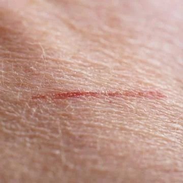 Skin cut macro Stock Photos
