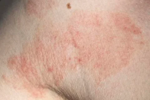 Skin dermatitis Stock Photos