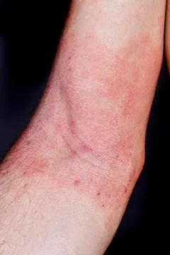 Skin dermatitis Stock Photos