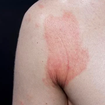 Skin dermatitis Stock Photos