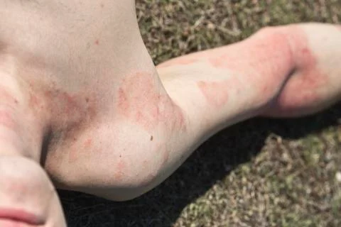 Skin dermatitis Stock Photos