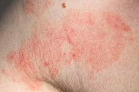Skin dermatitis Stock Photos