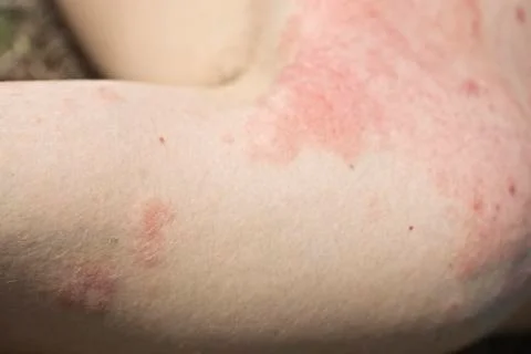 Skin dermatitis Stock Photos