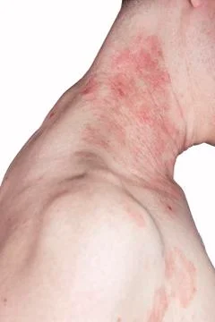 Skin dermatitis Stock Photos