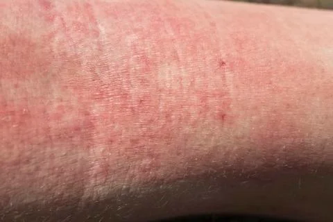 Skin dermatitis Stock Photos