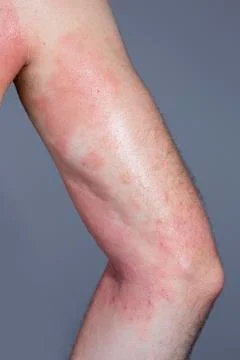 Skin dermatitis Stock Photos