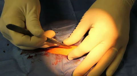 Skin incision Stock Footage 1014466