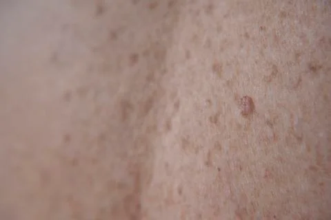 The skin with moles Stock Photos