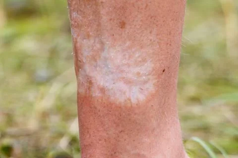 Skin patch on human leg, light coloration Stock Photos
