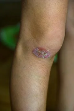 Skin patch on knee shows redness and scabbing Stock Photos