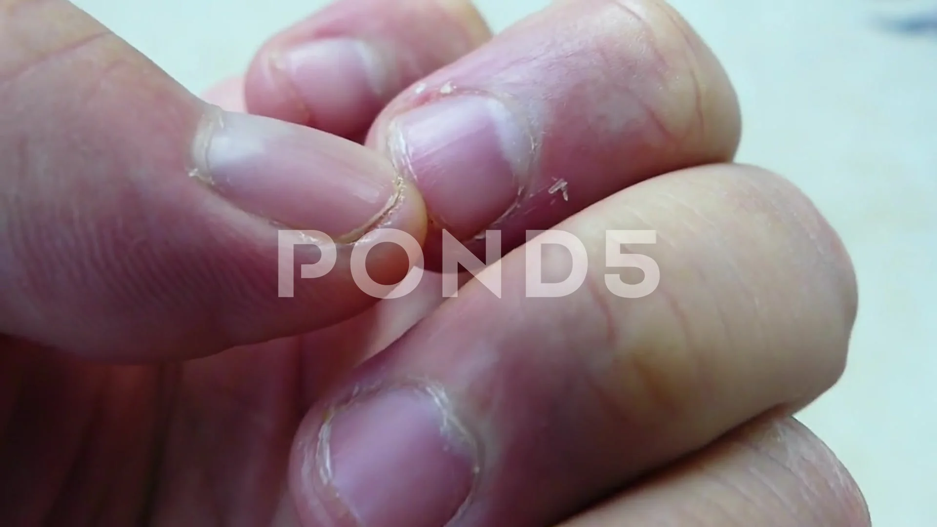 Irritated skin peeling on fingertips due to direct damage to the skin such  as infection of nail biting habit or dryness, Healt… | Peeling skin,  Irritated skin, Skin