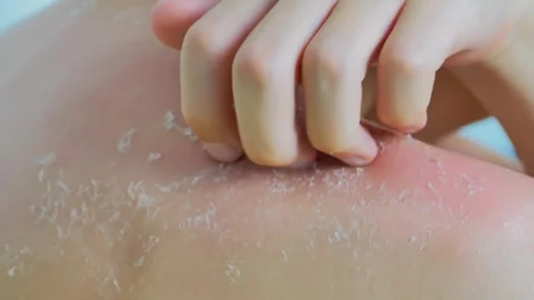 Skin peels off after sunburn Stock Footage 243934498
