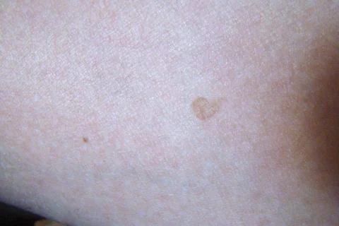 Skin pigmentation Stock Photos