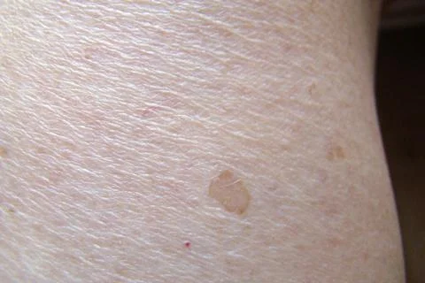 Skin pigmentation Stock Photos