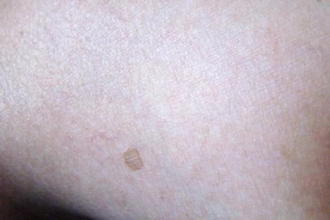 Skin pigmentation Stock Photos