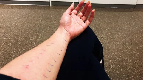 Skin Prick Allergy Test Stock Footage 101737280