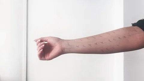 Skin Prick Allergy Test Stock Footage 101737532