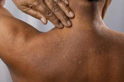 Skin problem for adults Foto stock