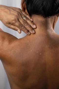 Skin problem for adults Stock Photos