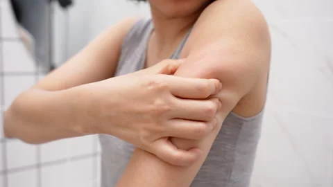 Skin problem and beauty. Young woman scratch body has itchy skin from skin .. Stock Footage 341305725