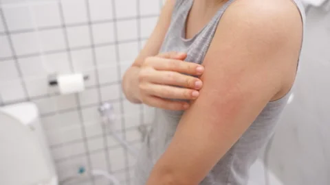 Skin problem and beauty. Young woman scratch body has itchy skin from skin .. Stock Footage 341368786