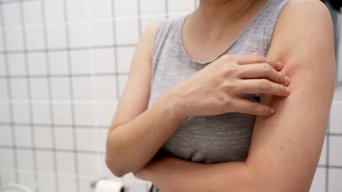 Skin problem and beauty. Young woman scratch body has itchy skin from skin .. Stock Footage 341834332