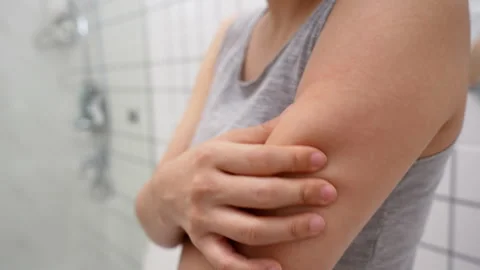 Skin problem and beauty. Young woman scratch body has itchy skin from skin .. Stock Footage 342082827
