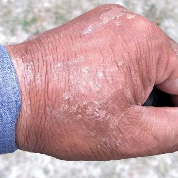 Skin problem Stock Photos