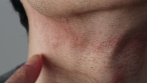 Skin problems after shaving Stock Footage 324549280