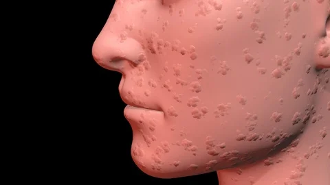 Skin Problems : red bumpy infected skin  forming on face. 3d animation Stock Footage 99326086