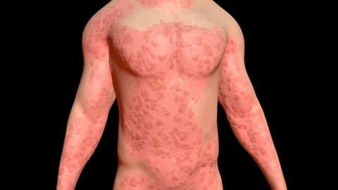 Skin Problems : red bumpy infected skin healing. 3d animation Stock Footage 99326141