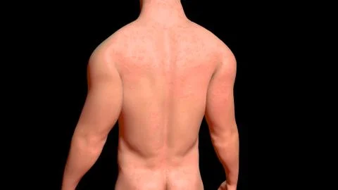 Skin Problems :red bumpy infected skin on torso . 3d render Illustrazione stock