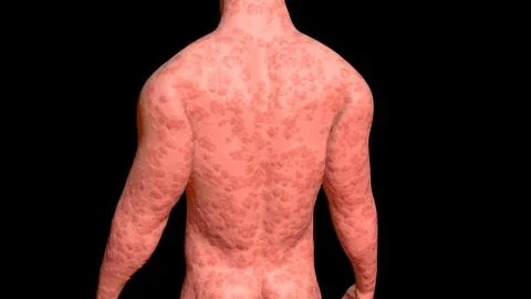 Skin Problems :red bumpy infected skin on torso . 3d render 스톡 일러스트