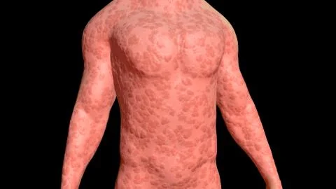 Skin Problems :red bumpy infected skin on torso . 3d render Stock Illustration