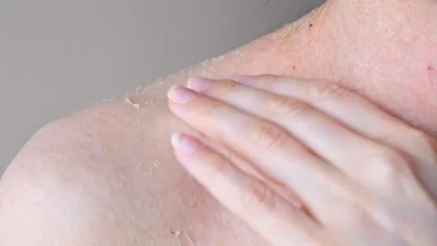 Skin problems on shoulder close-up effect of dehydration on problem skin Stock Footage 259893288