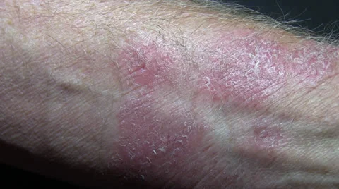 Skin rash Stock Footage 24769845