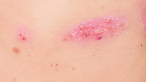 skin rash treatment on woman body. Shingles, Disease, Herpes
