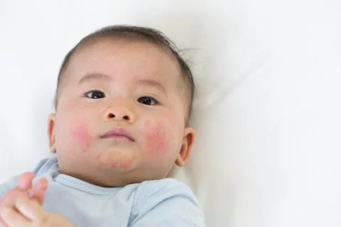 Skin rashes in babies concept 写真素材