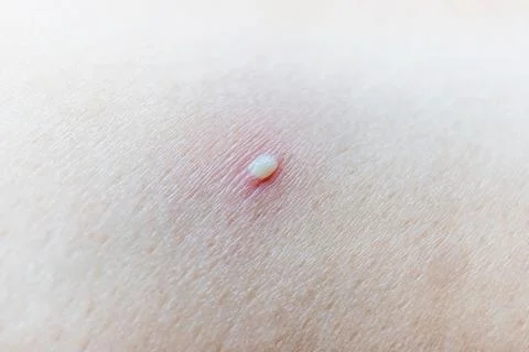 Skin with a small white pustule surrounded by redness and inflammation, acn.. Stock Photos