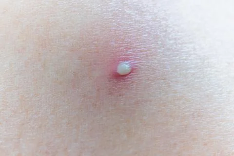 Skin with a small white pustule surrounded by redness and inflammation, acn.. Stock Photos