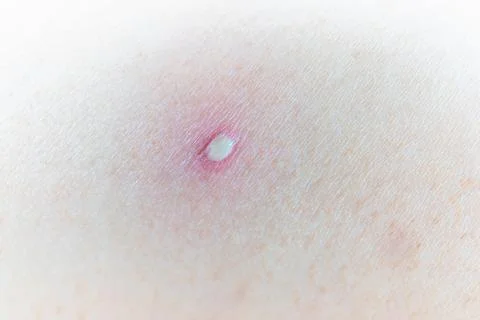 Skin with a small white pustule surrounded by redness and inflammation, acn.. Stock Photos