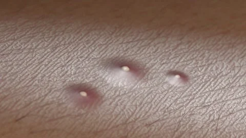Skin surface acne growing and shrink macro, looped switch 스톡 동영상 313886318