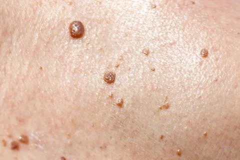 Skin surface shows multiple small brownish growths Stock Photos