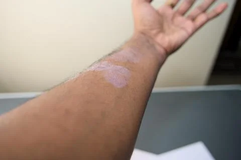 Skin texture and healing process on a human arm 스톡 사진