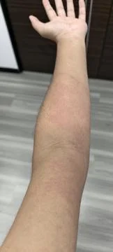 A skin with urticaria. Fotos de archivo